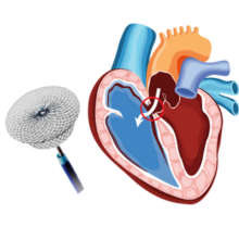 Atrial Septal Defect