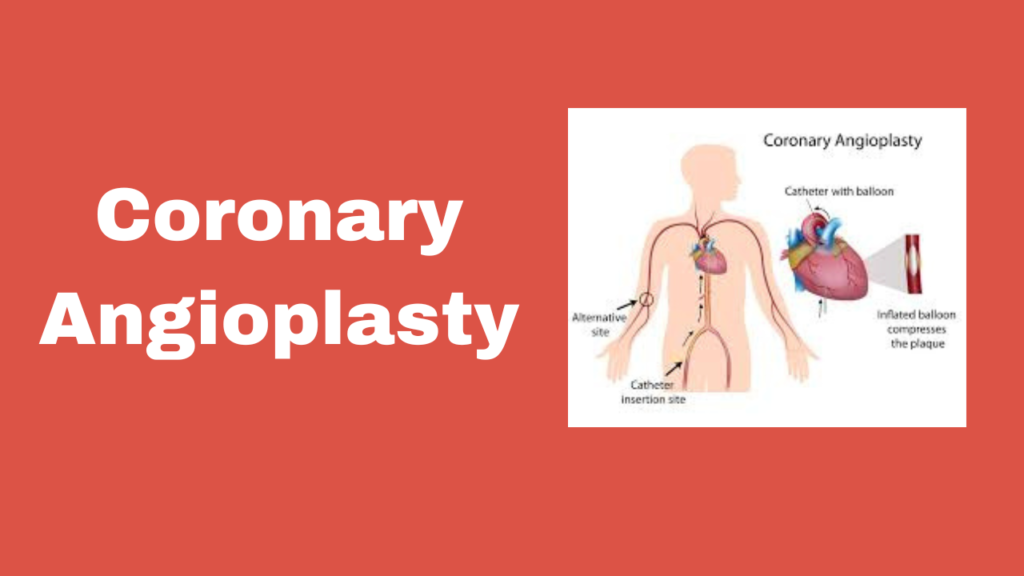 Coronary Angioplasty