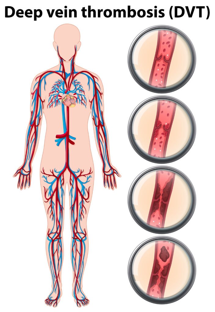 Deep vein thrombosis anatomy illustration